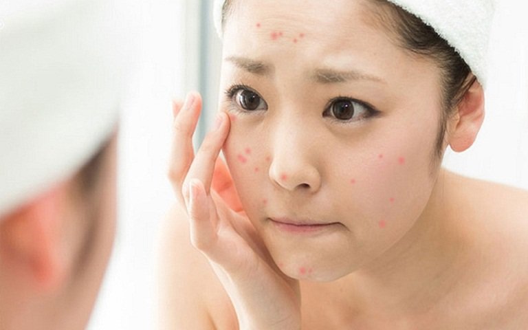 Thói quen hạn chế nổi mụn trong mùa nắng nóng